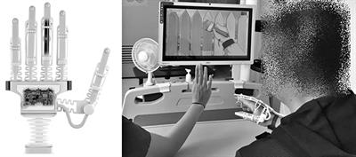 Effects of Upper-Extremity Rehabilitation Using Smart Glove in Patients With Subacute Stroke: Results of a Prematurely Terminated Multicenter Randomized Controlled Trial